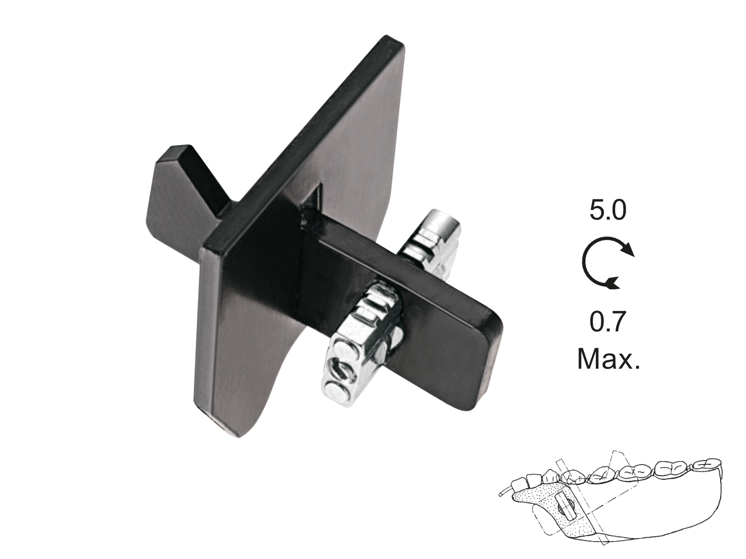 Memory Schraube Dehnschraube Unterkiefer