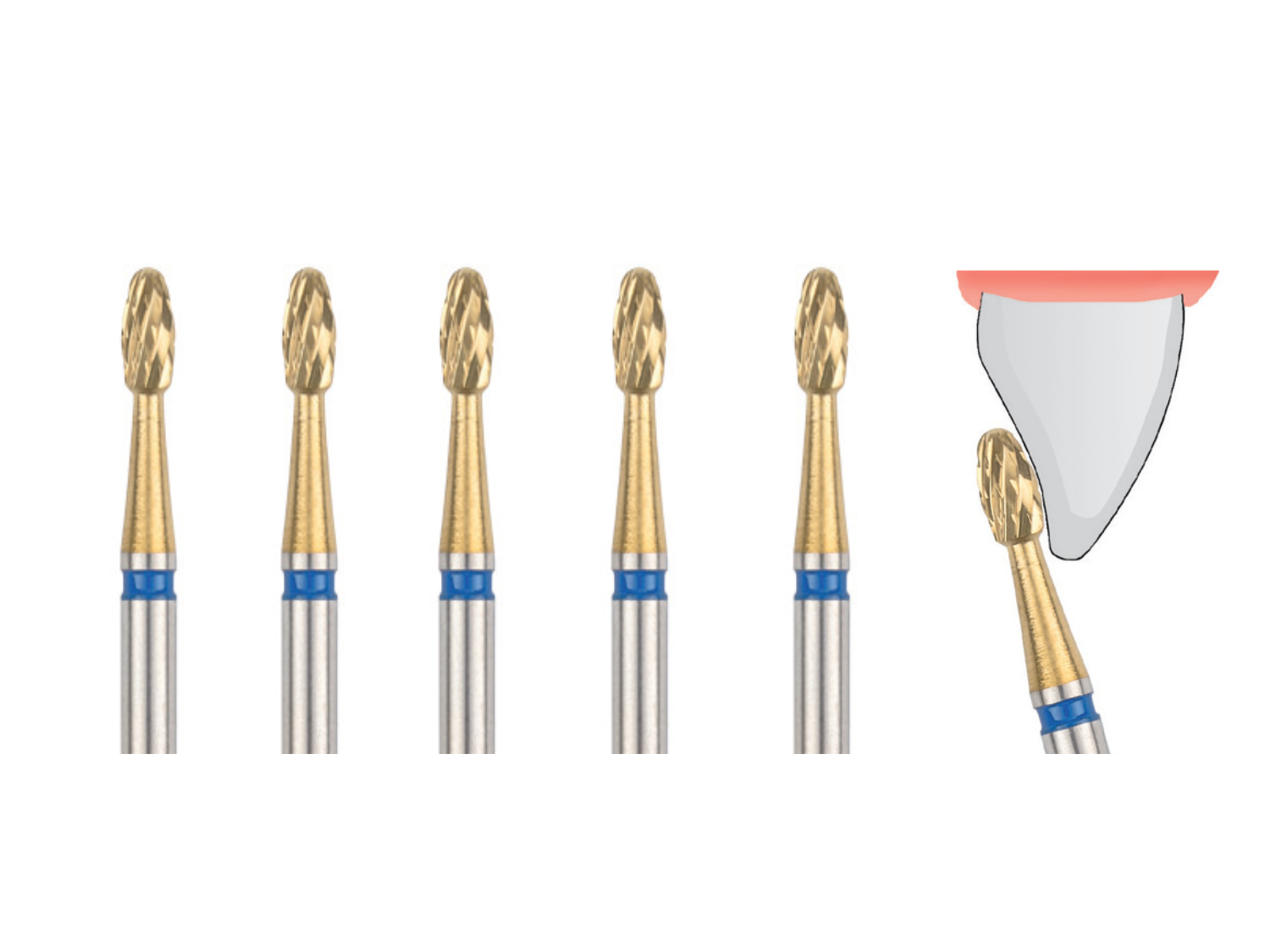 Titan-Nitrit Finierer fein .018 Klebstoffentferner für Winkelstück (5 Stück)
